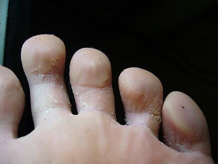 Peeling and peeling skin on the feet is a sign of fungus