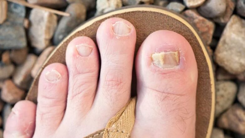 Mognos of nails