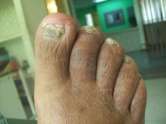 The lesion of fungi