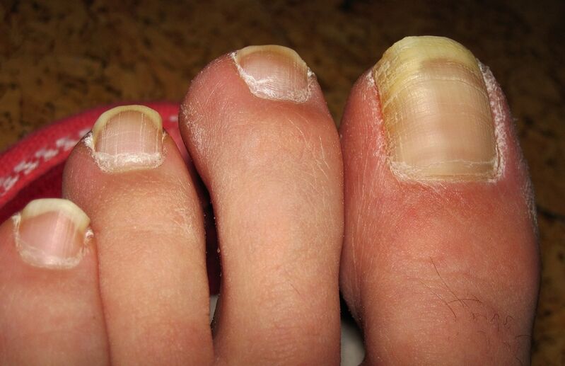 yellowing of toenails with fungus