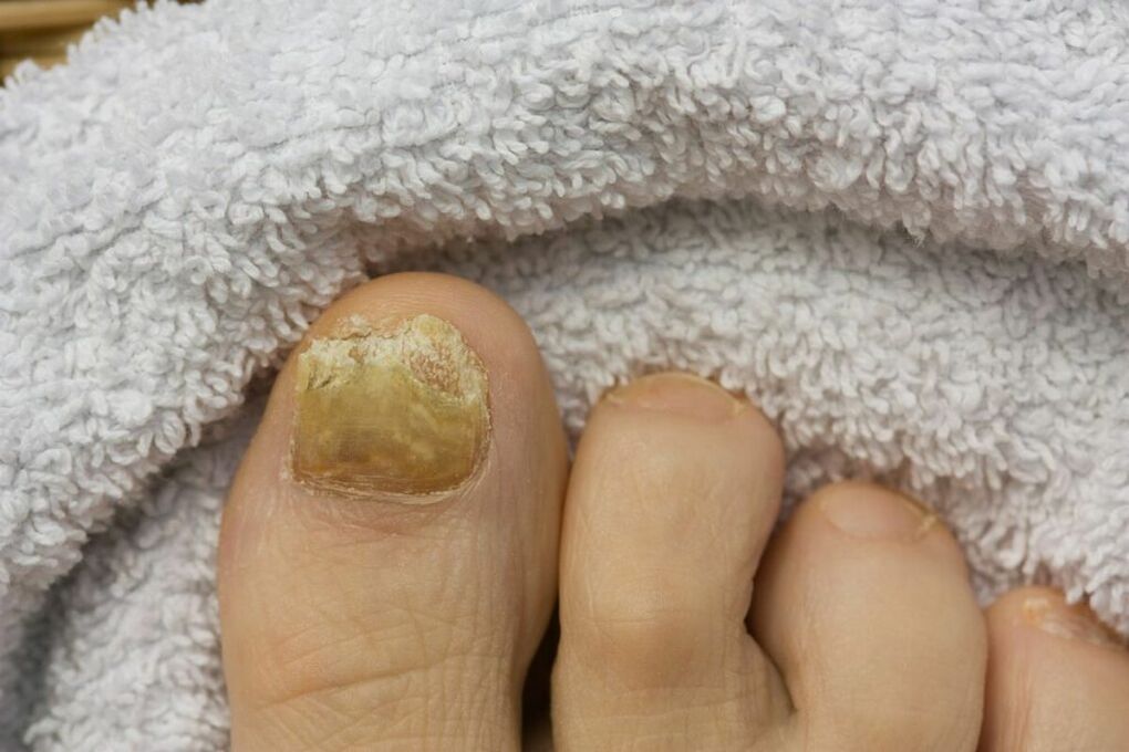 Atrophic stage of the fungus (decay of toenails)