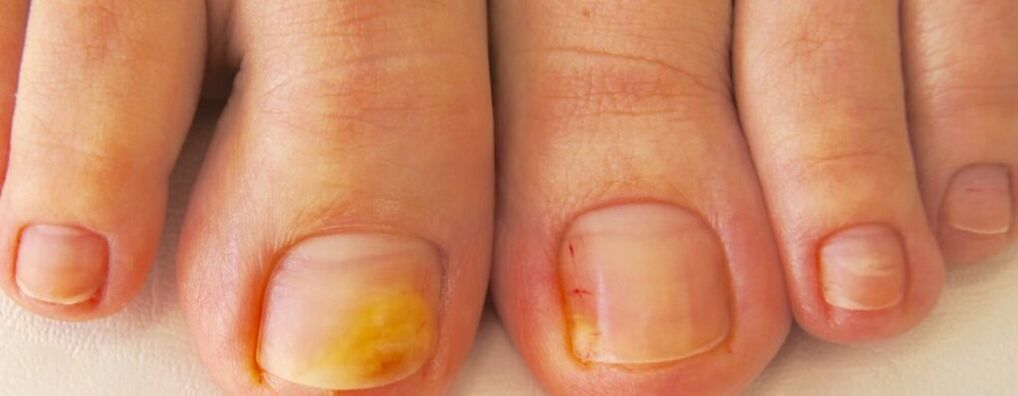 The initial stage of onychomycosis is yellowing of the toenails