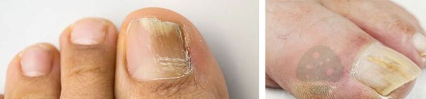 Thumb nail mushroom