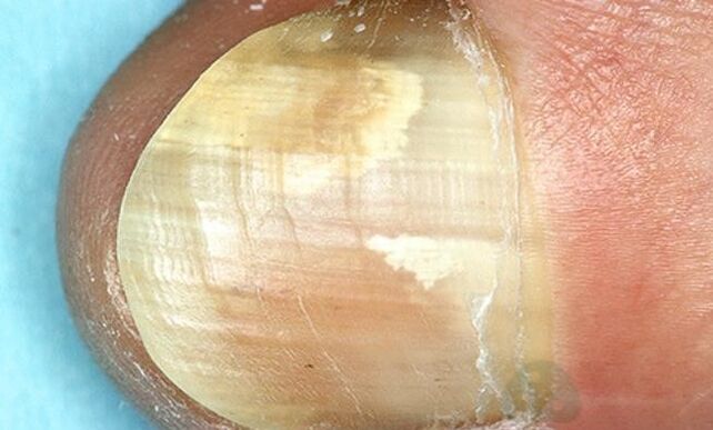 Treatment of the tip of your fingers with internal activity medications