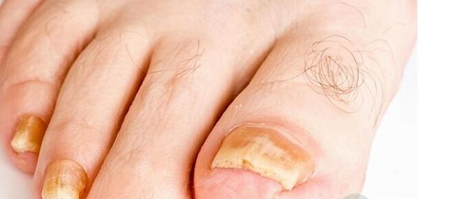 Types of finger nail fungi