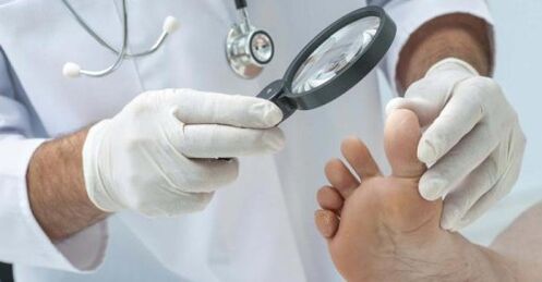Treatment of foot fungus by a doctor