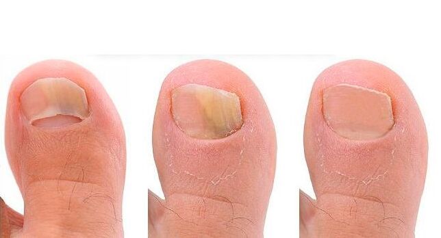 developmental stages of nail fungus