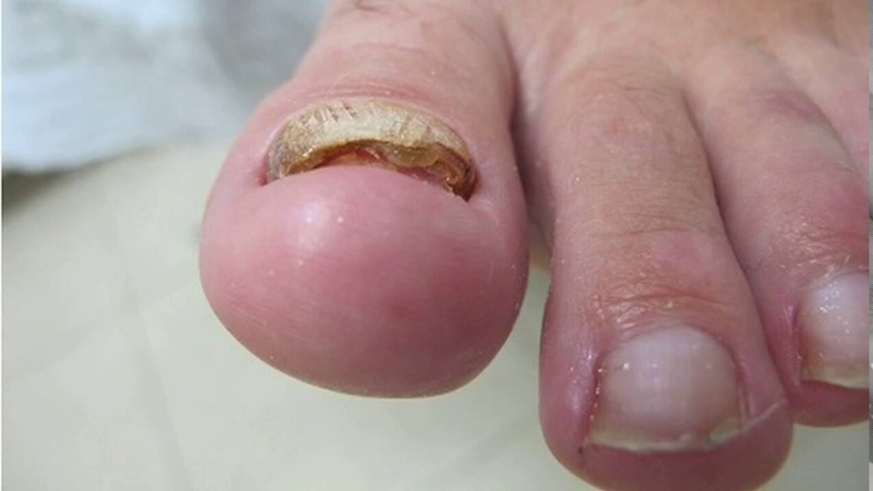 Hypertrophic fungus - deformation of the edge, loss of color and thickening of the nail plate