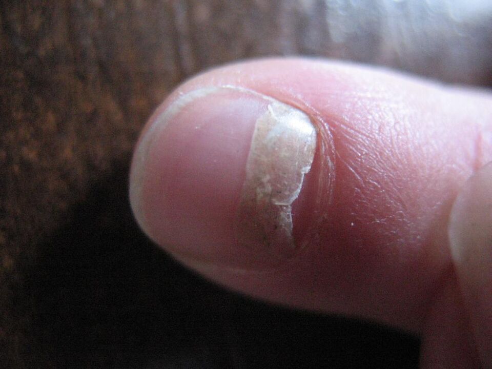 The onycholytic type of fungus is accompanied by separation of the nail plate