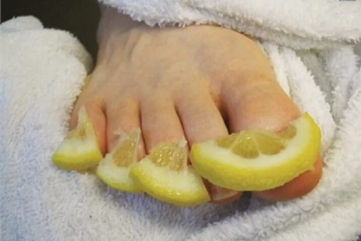 Compresses from lemon drops - a folk remedy for nail fungus