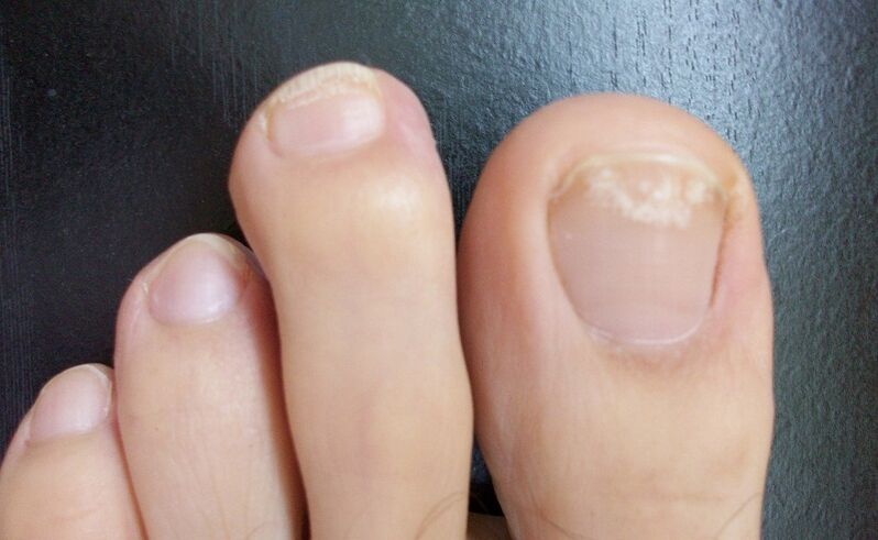 The first signs of the fungus are a change in the color of the nail plate, the appearance of spots