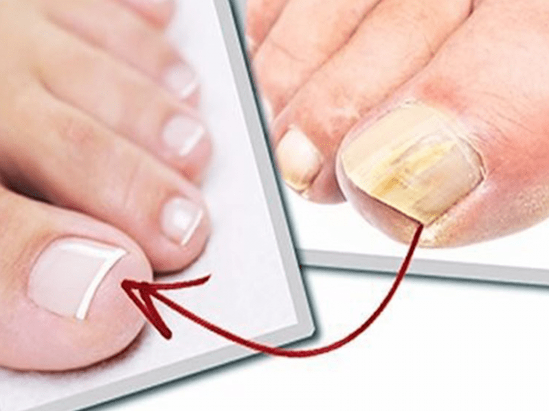 Toenails affected by fungus and healthy nails after home treatment