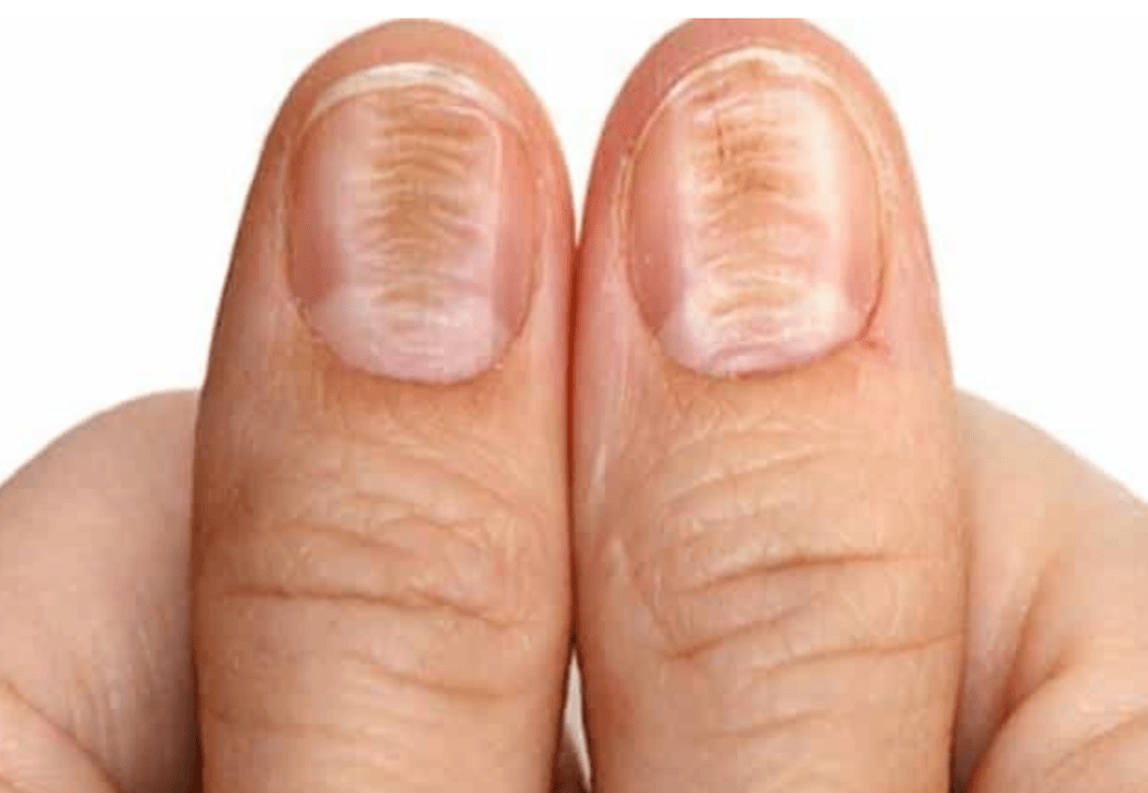 change in nail color and structure