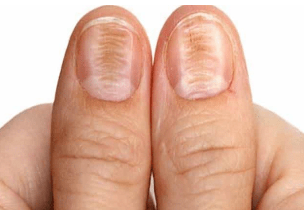 changes in the color and structure of the nail